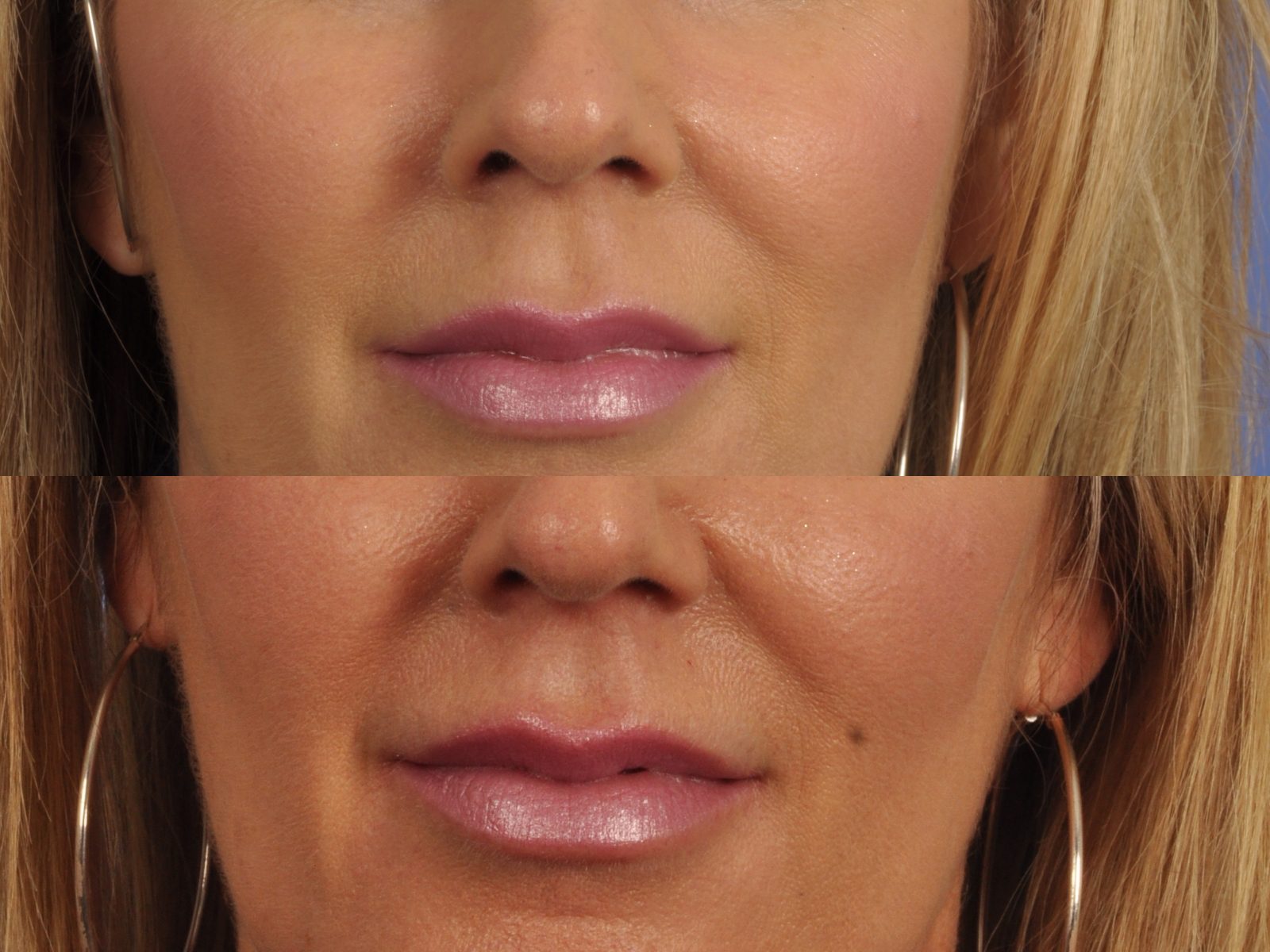 Filler before after photos w cosmetic surgery