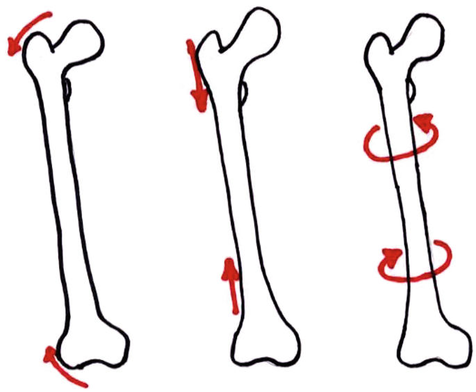 Understanding and appreciating fracture and fixation stability