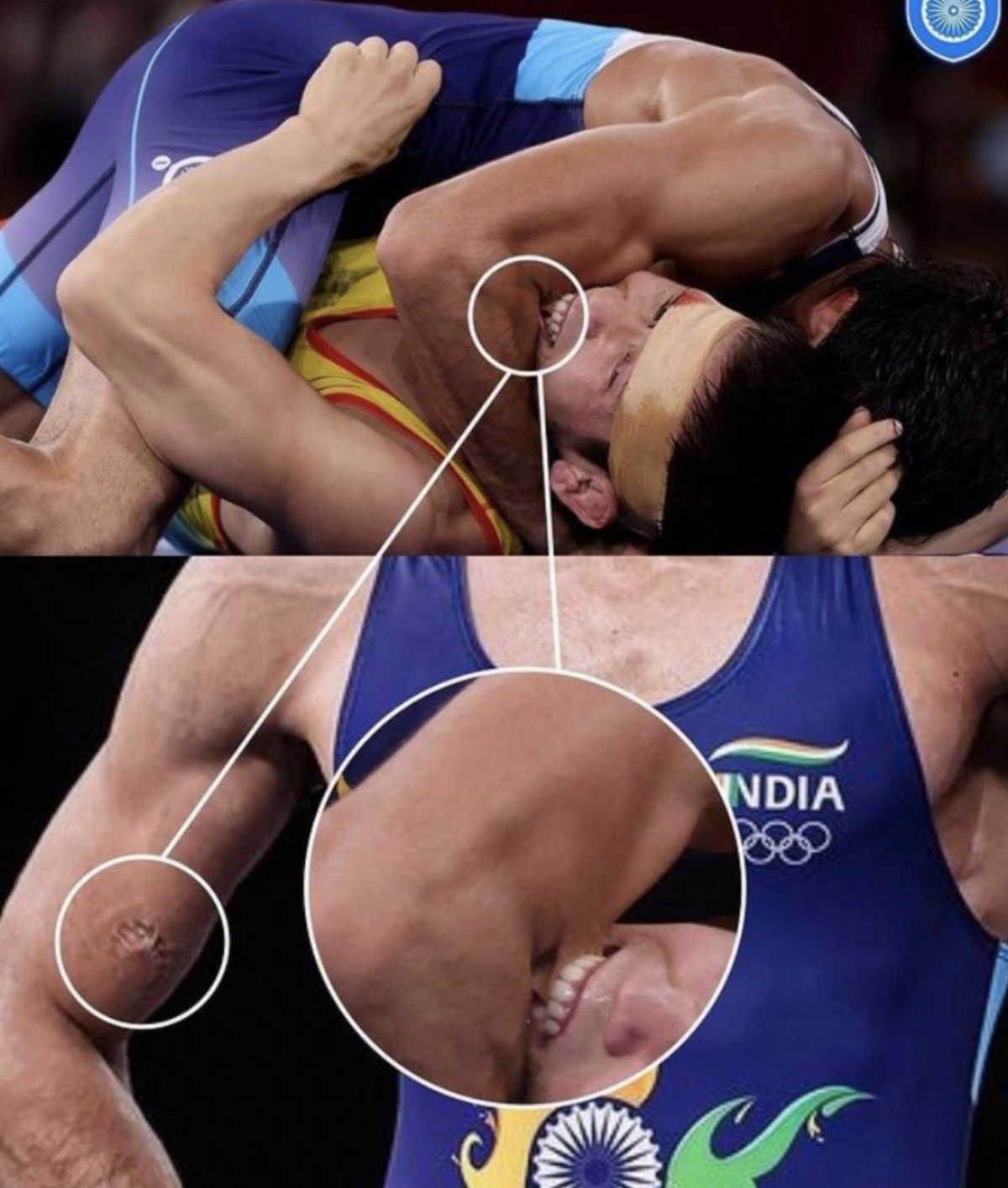 Watch wrestler dahiya endures bite on arm en route historic win
