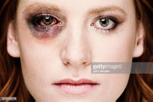 Woman with black eye photos and premium high res pictures
